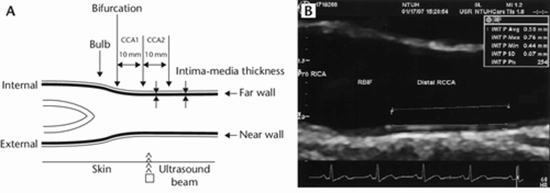 tickness of carotid artery in patients with chronic graft-versus-host disease  {faces}